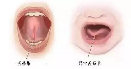 舌系帶過長影響孩子發(fā)音，嚴重不會說話